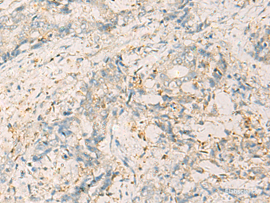 Immunohistochemistry of paraffin-embedded Human cervical cancer tissue  using WDR37 Polyclonal Antibody at dilution of 1:50(×200)