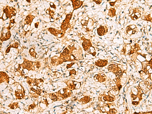 Immunohistochemistry of paraffin-embedded Human liver cancer tissue  using C11orf54 Polyclonal Antibody at dilution of 1:50(×200)