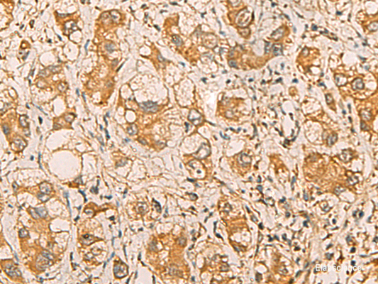Immunohistochemistry of paraffin-embedded Human liver cancer tissue  using MRPL9 Polyclonal Antibody at dilution of 1:55(×200)