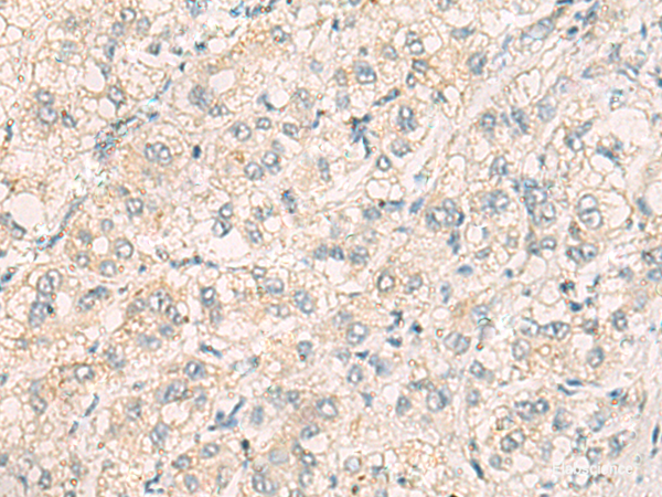 Immunohistochemistry of paraffin-embedded Human liver cancer tissue  using THG1L Polyclonal Antibody at dilution of 1:70(×200)