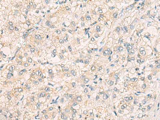 Immunohistochemistry of paraffin-embedded Human liver cancer tissue  using THG1L Polyclonal Antibody at dilution of 1:70(×200)