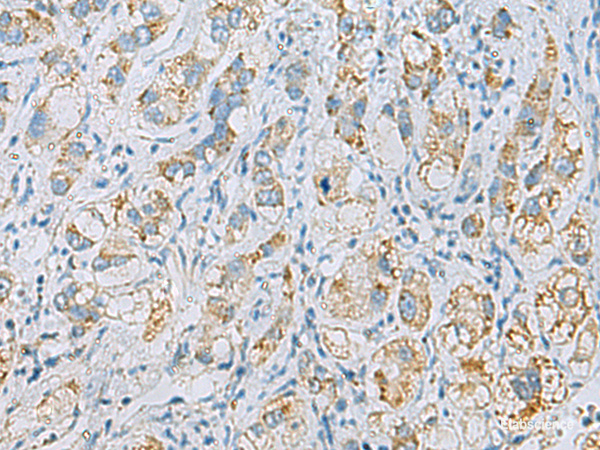 Immunohistochemistry of paraffin-embedded Human liver cancer tissue  using PLA2G15 Polyclonal Antibody at dilution of 1:65(×200)