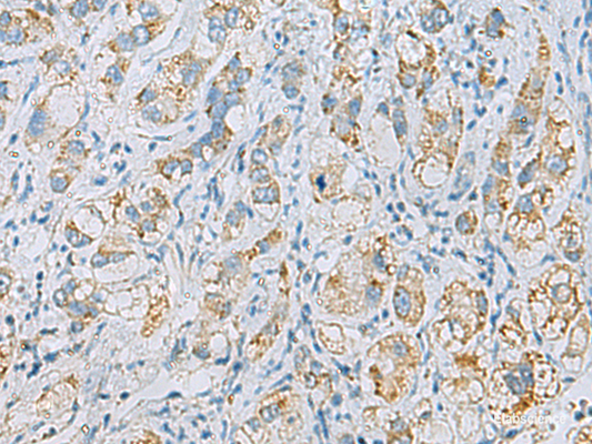 Immunohistochemistry of paraffin-embedded Human liver cancer tissue  using PLA2G15 Polyclonal Antibody at dilution of 1:65(×200)