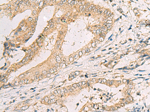 Immunohistochemistry of paraffin-embedded Human cervical cancer tissue  using SPACA1 Polyclonal Antibody at dilution of 1:50(×200)