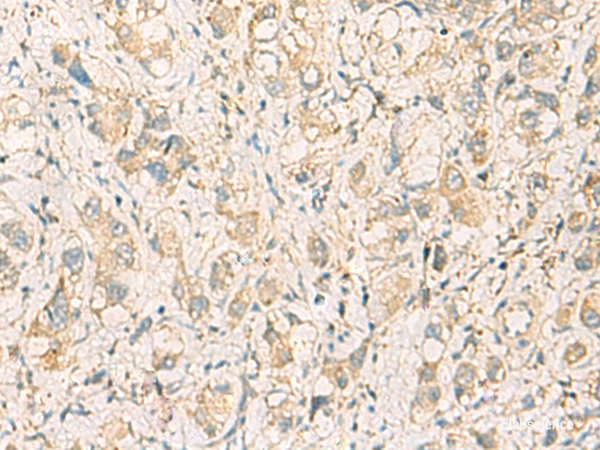 Immunohistochemistry of paraffin-embedded Human liver cancer tissue  using F11R Polyclonal Antibody at dilution of 1:40(×200)