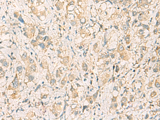Immunohistochemistry of paraffin-embedded Human liver cancer tissue  using F11R Polyclonal Antibody at dilution of 1:40(×200)