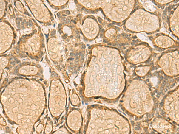 Immunohistochemistry of paraffin-embedded Human thyroid cancer tissue  using HORMAD2 Polyclonal Antibody at dilution of 1:45(×200)