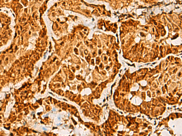 Immunohistochemistry of paraffin-embedded Human thyroid cancer tissue  using SAP30BP Polyclonal Antibody at dilution of 1:40(×200)