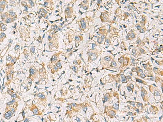 Immunohistochemistry of paraffin-embedded Human liver cancer tissue  using PDE4DIP Polyclonal Antibody at dilution of 1:60(×200)