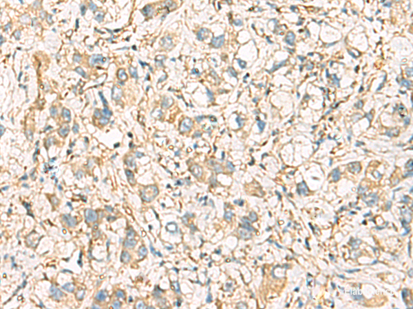 Immunohistochemistry of paraffin-embedded Human liver cancer tissue  using IDS Polyclonal Antibody at dilution of 1:60(×200)