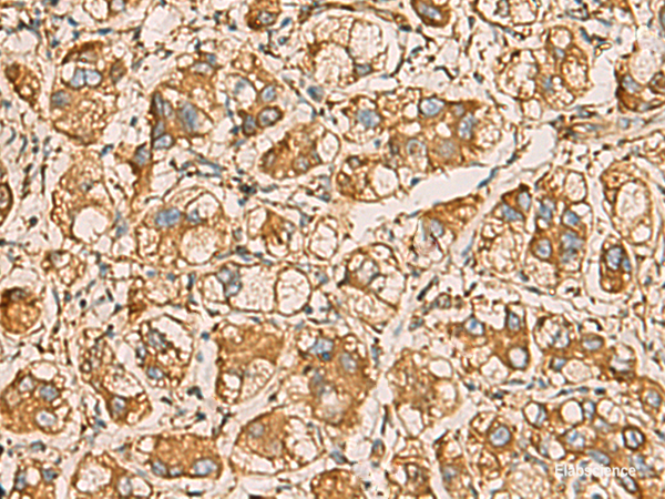 Immunohistochemistry of paraffin-embedded Human liver cancer tissue  using AIMP1 Polyclonal Antibody at dilution of 1:55(×200)
