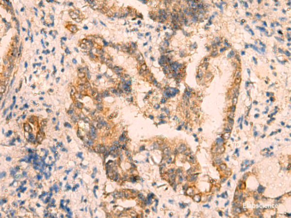 Immunohistochemistry of paraffin-embedded Human cervical cancer tissue  using CRYM Polyclonal Antibody at dilution of 1:65(×200)