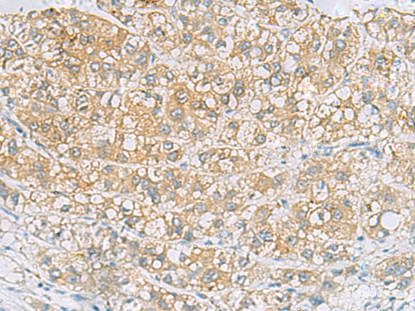 Immunohistochemistry of paraffin-embedded Human liver cancer tissue  using EPCAM Polyclonal Antibody at dilution of 1:60(×200)