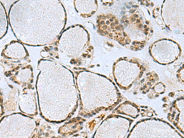 Immunohistochemistry of paraffin-embedded Human thyroid cancer tissue  using PTPA Polyclonal Antibody at dilution of 1:50(×200)