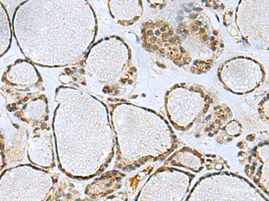 Immunohistochemistry of paraffin-embedded Human thyroid cancer tissue  using PTPA Polyclonal Antibody at dilution of 1:50(×200)
