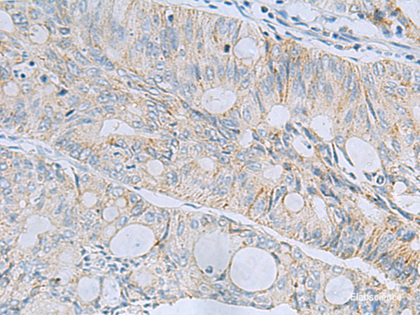 Immunohistochemistry of paraffin-embedded Human colorectal cancer tissue  using MSI2 Polyclonal Antibody at dilution of 1:60(×200)