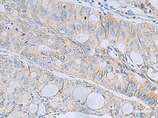 Immunohistochemistry of paraffin-embedded Human colorectal cancer tissue  using MSI2 Polyclonal Antibody at dilution of 1:60(×200)