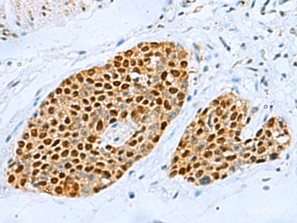 Immunohistochemistry of paraffin-embedded Human esophagus cancer tissue  using TFAP4 Polyclonal Antibody at dilution of 1:70(×200)