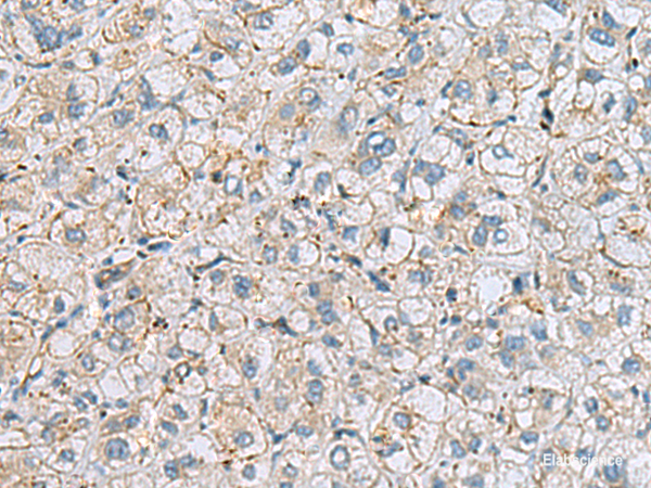 Immunohistochemistry of paraffin-embedded Human liver cancer tissue  using MTHFD2 Polyclonal Antibody at dilution of 1:65(×200)