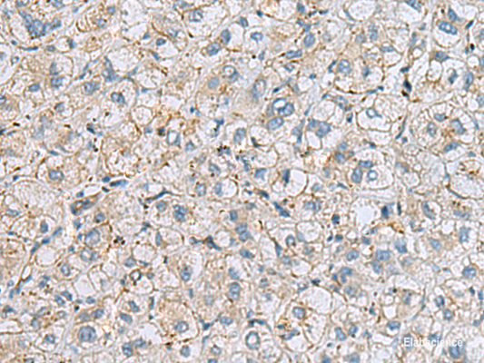 Immunohistochemistry of paraffin-embedded Human liver cancer tissue  using MTHFD2 Polyclonal Antibody at dilution of 1:65(×200)