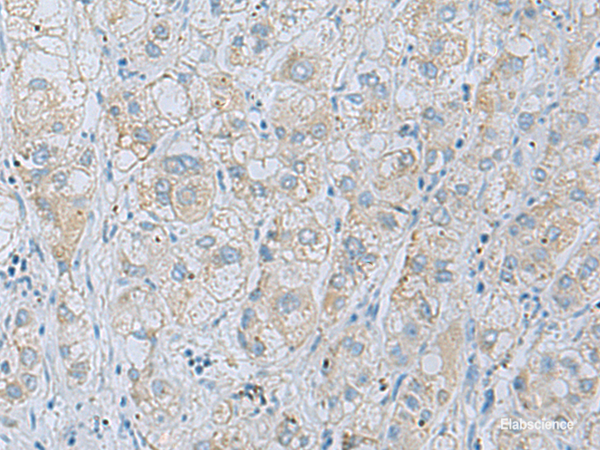 Immunohistochemistry of paraffin-embedded Human liver cancer tissue  using NAGK Polyclonal Antibody at dilution of 1:35(×200)