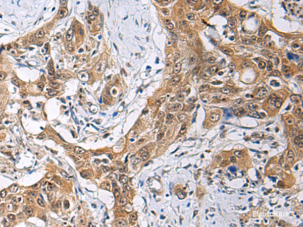 Immunohistochemistry of paraffin-embedded Human esophagus cancer tissue  using THOC3 Polyclonal Antibody at dilution of 1:85(×200)