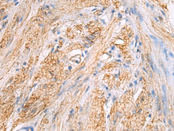 Immunohistochemistry of paraffin-embedded Human gastric cancer tissue  using TMOD3 Polyclonal Antibody at dilution of 1:70(×200)