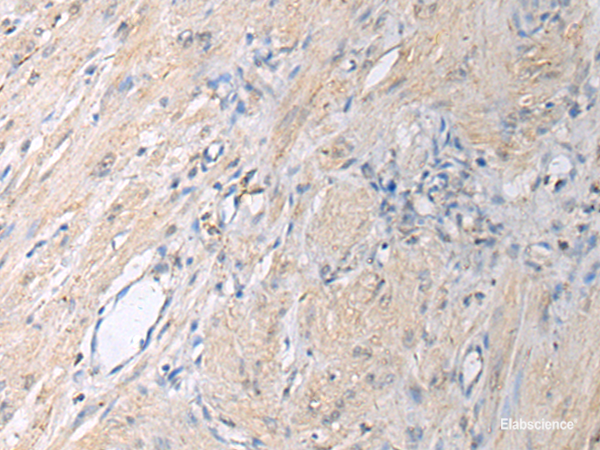 Immunohistochemistry of paraffin-embedded Human gastric cancer tissue  using GNAI1 Polyclonal Antibody at dilution of 1:130(×200)