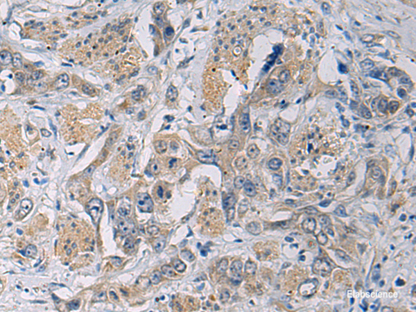 Immunohistochemistry of paraffin-embedded Human esophagus cancer tissue  using CYTIP Polyclonal Antibody at dilution of 1:50(×200)