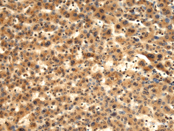 Immunohistochemistry of paraffin-embedded Human liver cancer tissue  using TMOD1 Polyclonal Antibody at dilution of 1:60(×200)