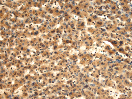 Immunohistochemistry of paraffin-embedded Human liver cancer tissue  using TMOD1 Polyclonal Antibody at dilution of 1:60(×200)