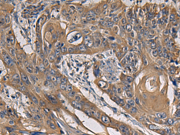 Immunohistochemistry of paraffin-embedded Human esophagus cancer tissue  using CCNI Polyclonal Antibody at dilution of 1:65(×200)