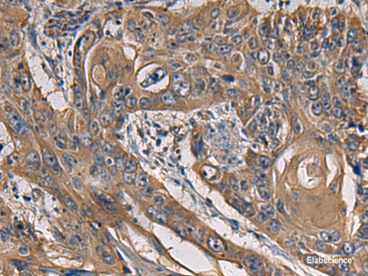 Immunohistochemistry of paraffin-embedded Human esophagus cancer tissue  using CCNI Polyclonal Antibody at dilution of 1:65(×200)