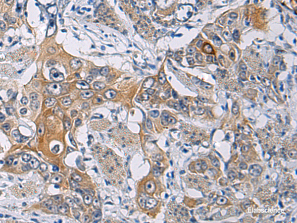 Immunohistochemistry of paraffin-embedded Human esophagus cancer tissue  using KCNJ10 Polyclonal Antibody at dilution of 1:60(×200)