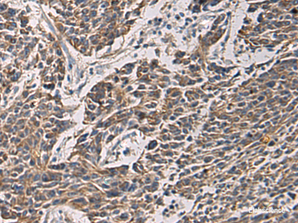 Immunohistochemistry of paraffin-embedded Human colorectal cancer tissue  using MAPKAPK3 Polyclonal Antibody at dilution of 1:95(×200)