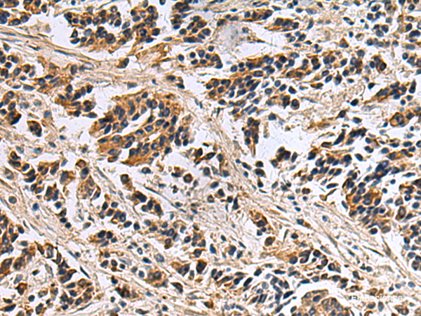 Immunohistochemistry of paraffin-embedded Human breast cancer tissue  using DIAPH2 Polyclonal Antibody at dilution of 1:55(×200)