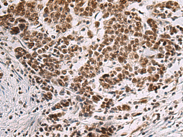 Immunohistochemistry of paraffin-embedded Human colorectal cancer tissue  using CREBBP Polyclonal Antibody at dilution of 1:60(×200)