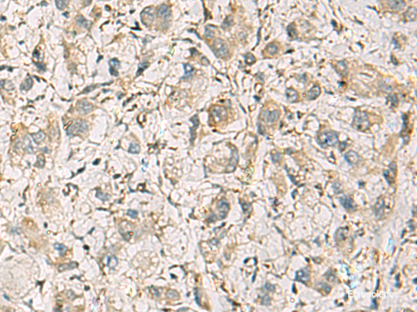 Immunohistochemistry of paraffin-embedded Human liver cancer tissue  using CMTM1 Polyclonal Antibody at dilution of 1:40(×200)