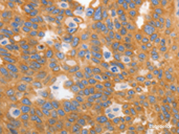 Immunohistochemistry of paraffin-embedded Human ovarian cancer tissue  using MYOD1 Polyclonal Antibody at dilution of 1:120(×200)