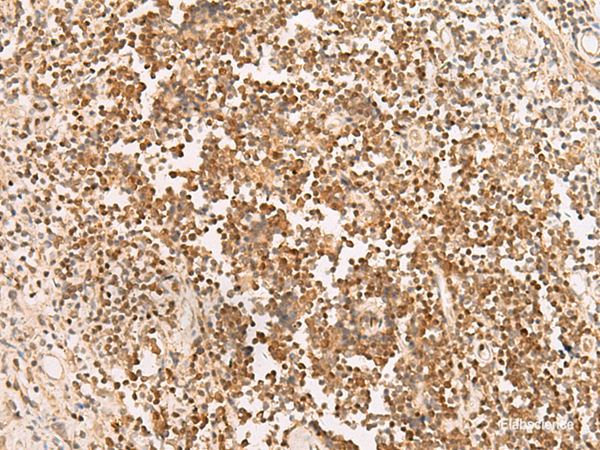 Immunohistochemistry of paraffin-embedded Human prost at e cancer tissue  using PAX5 Polyclonal Antibody at dilution of 1:30(×200)