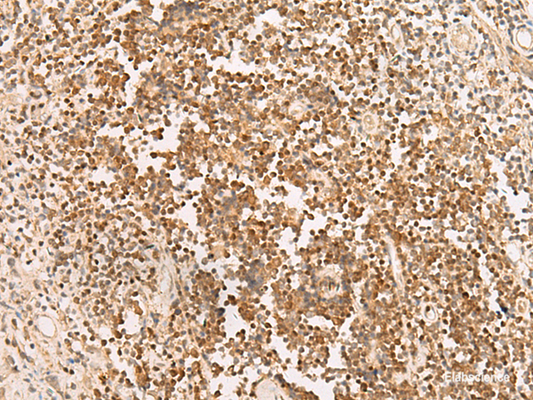 Immunohistochemistry of paraffin-embedded Human prost at e cancer tissue  using PAX5 Polyclonal Antibody at dilution of 1:30(×200)