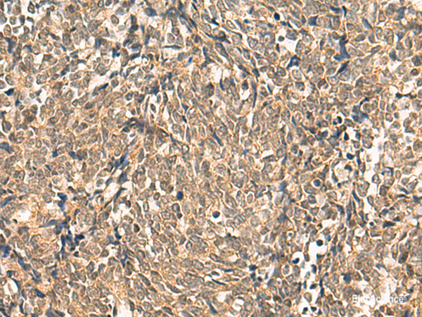 Immunohistochemistry of paraffin-embedded Human lung cancer tissue  using HNF1A Polyclonal Antibody at dilution of 1:50(×200)