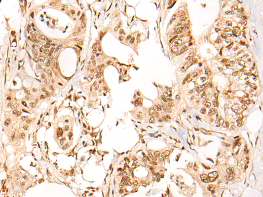 Immunohistochemistry of paraffin-embedded Human colorectal cancer tissue  using ARID1B Polyclonal Antibody at dilution of 1:40(×200)