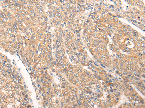 Immunohistochemistry of paraffin-embedded Human liver cancer tissue  using PIAS3 Polyclonal Antibody at dilution of 1:40(×200)