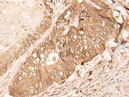 Immunohistochemistry of paraffin-embedded Human colorectal cancer tissue  using HIPK3 Polyclonal Antibody at dilution of 1:60(×200)