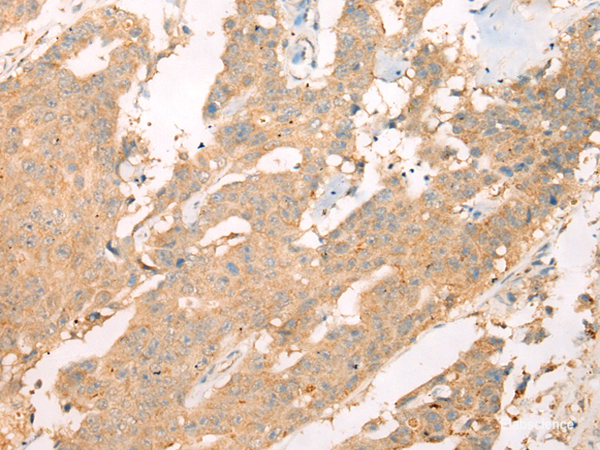 Immunohistochemistry of paraffin-embedded Human colorectal cancer tissue  using ASIC3 Polyclonal Antibody at dilution of 1:40(×200)