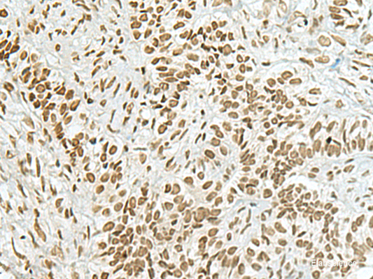 Immunohistochemistry of paraffin-embedded Human ovarian cancer tissue  using HAS1 Polyclonal Antibody at dilution of 1:70(×200)