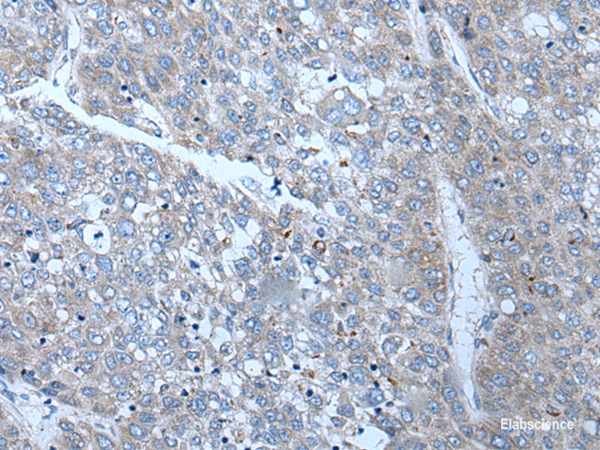 Immunohistochemistry of paraffin-embedded Human liver cancer tissue  using SLC24A5 Polyclonal Antibody at dilution of 1:50(×200)