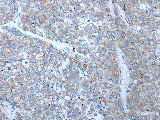 Immunohistochemistry of paraffin-embedded Human liver cancer tissue  using SLC24A5 Polyclonal Antibody at dilution of 1:50(×200)