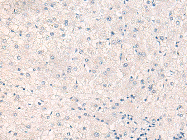 Immunohistochemistry of paraffin-embedded Human liver cancer tissue  using CEBPB  Polyclonal Antibody at dilution of 1:30(×200)